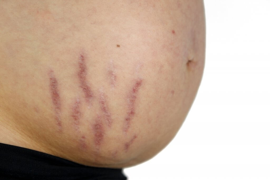 Haarausfall und andere Tabuthemen während und nach der Schwangerschaft
